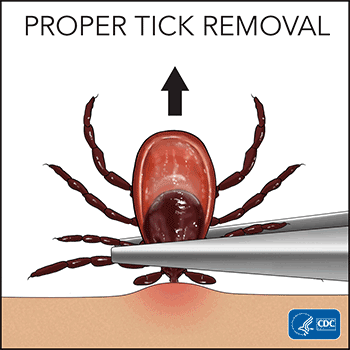 tick removal gif cdc